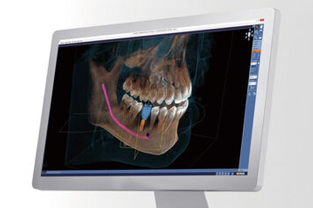 足立区六町・ほまれ歯科医院・3D映像で精密に診査診断できる「歯科用CT」